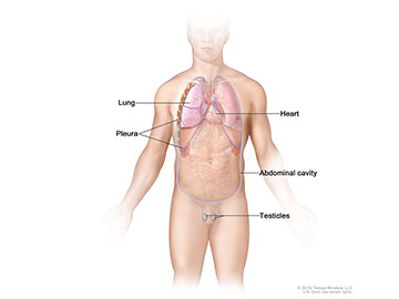 Malignant mesothelioma forms in the thin layer of tissue that covers the lung, chest wall, abdomen, heart, or testicles.