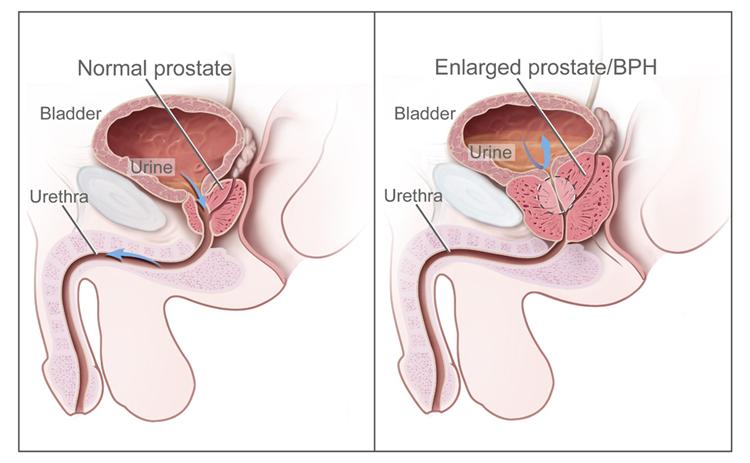 Urine flow in a normal and enlarged prostate. In diagram on the left, urine flows freely. On the right, urine flow is affected because the enlarged prostate is pressing on the bladder and urethra.