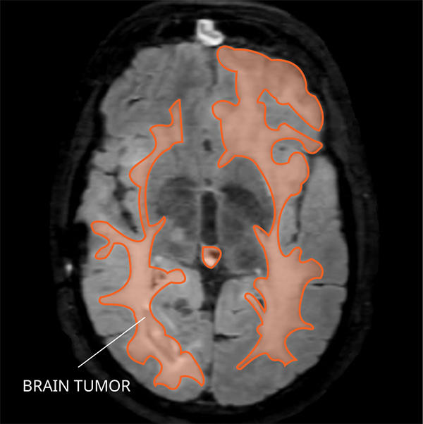 MRI of gliomatosis cerebri in the brain.