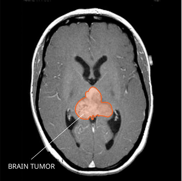 MRI scan showing an AT/RT tumor