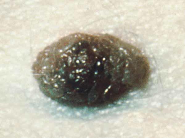 This common mole is about 5 millimeters in diameter.