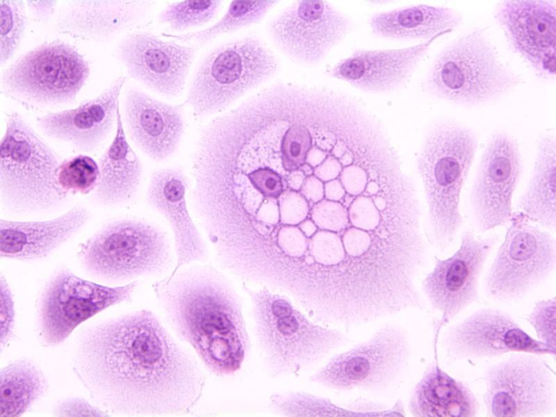 Microscopic image showing how cells infected by HPV can change.