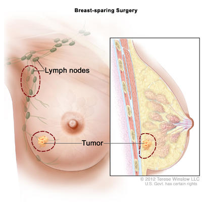 A drawing shows where breast-sparing surgery might remove tissue, such as around the tumor or lymph nodes under the arm.