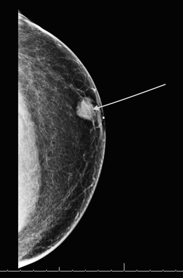 Mamografía diagnóstica muestra un tumor en el seno izquierdo de un paciente de sexo masculino.