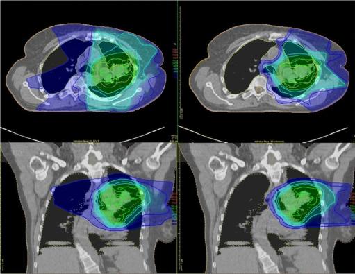 Scans of the chest after traditional radiation therapy and after proton therapy, which show how much surrounding tissue is affected by each type of therapy.
