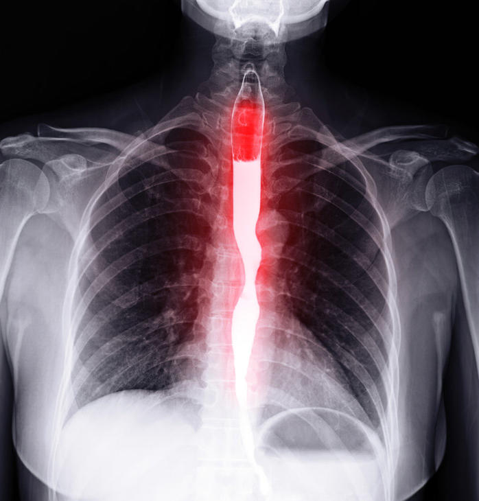 An x-ray of the esophagus shown with barium contrast.