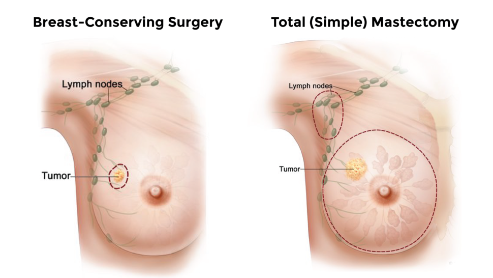 Side by side illustrations of breast-conserving surgery and a simple mastectomy.