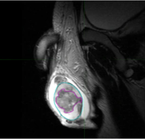 An MRI scan showing a testicular tumor.