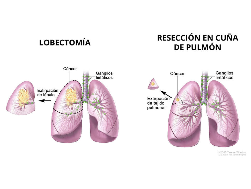 Se comparan dos imágenes de pulmón: a la izquierda se muestra una lobectomía y a la derecha se muestra una resección en cuña de pulmón.