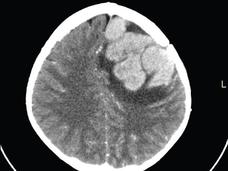 Exploración con tomografía computarizada (TC) de una recidiva tumoral en el cerebro de un niño con LLA.