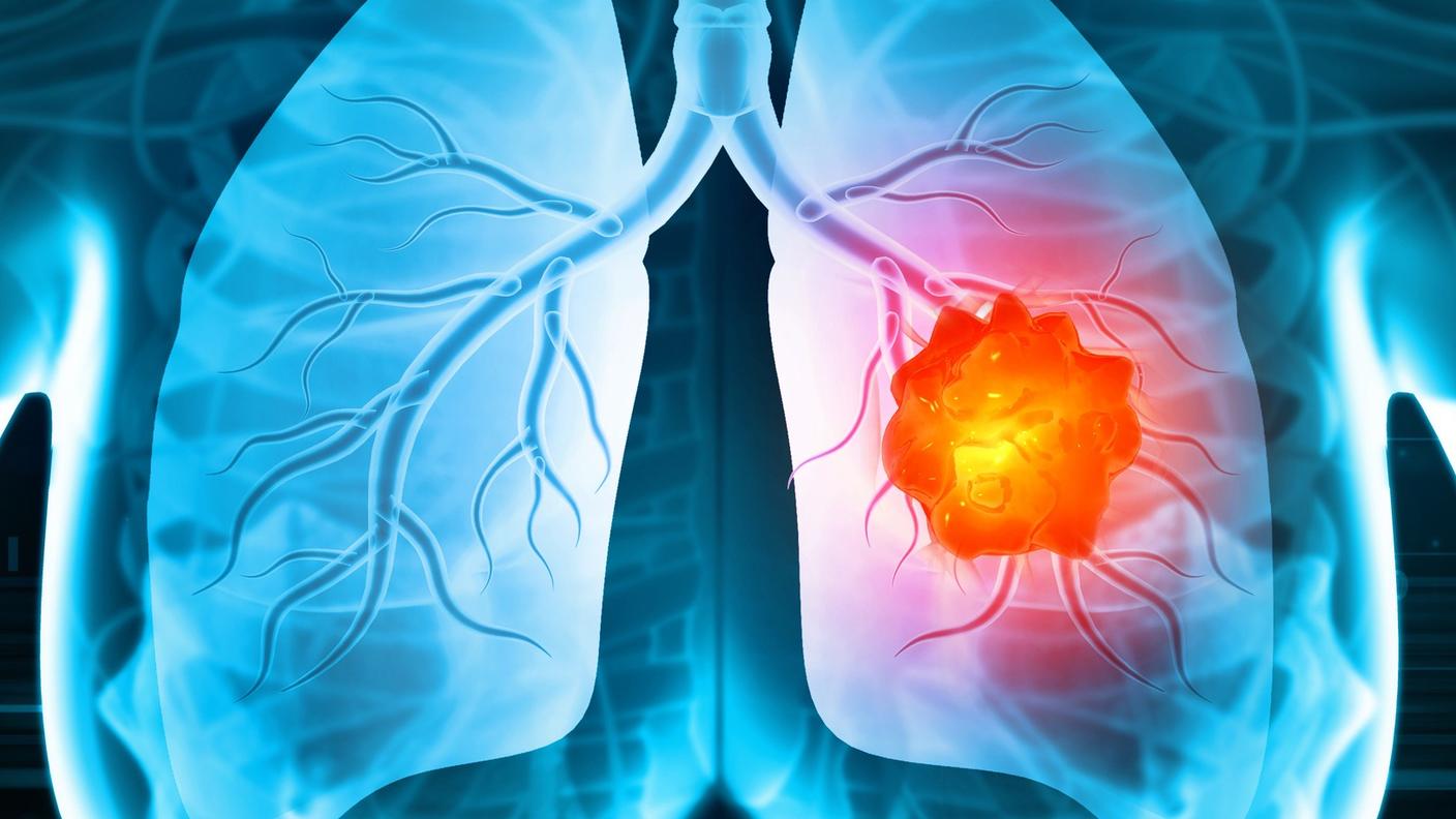 Ilustración estilizada de una radiografía de tórax con un tumor en color naranja brillante en el pulmón derecho.