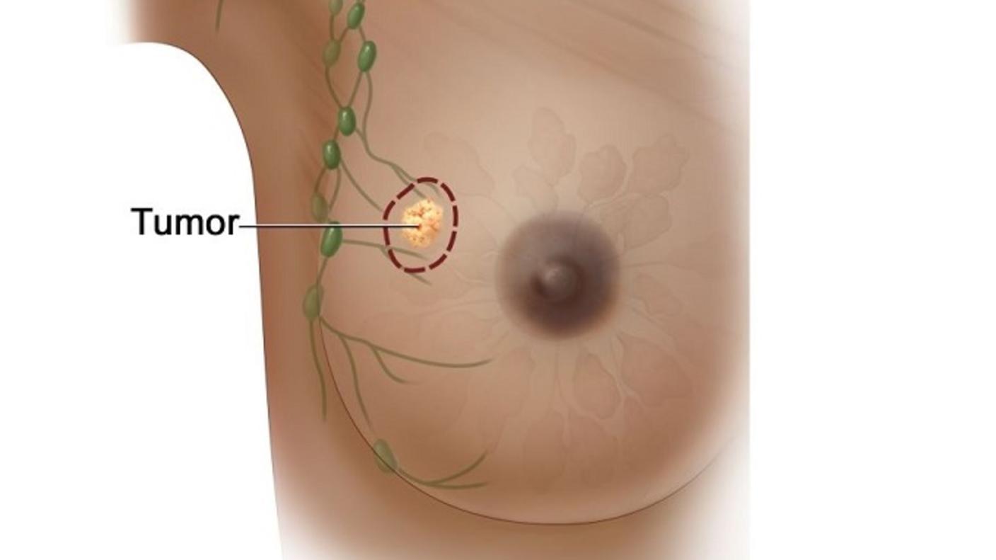 Imagen de una mama (seno) que muestra un tumor y la ubicación de los ganglios linfáticos cercanos.