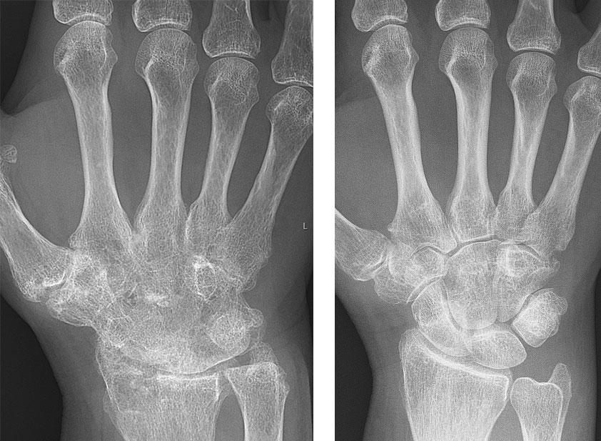 Radiografías de antes y después de la mano de una mujer con artritis reumatoide.