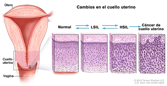 Estas imágenes muestran cómo las células de cuello uterino que tienen infecciones por el VPH de alto riesgo durante mucho tiempo, pueden cambiar y volverse anormales. Las células de cuello uterino anormales pueden volver a la normalidad incluso sin tratamiento, especialmente en las mujeres jóvenes. Las LSIL y HSIL son dos tipos de cambios anormales en las células escamosas de cuello uterino.