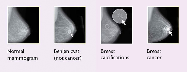 Four panel mammogram - the first shows a normal mammogram; the second shows a benign cyst; the third shows cancer; the forth shows calcium deposits in the breast