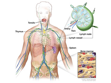 Anatomy of the lymph system, showing the lymph vessels and lymph organs including lymph nodes, tonsils, thymus, spleen, and bone marrow. Lymph (clear fluid) and lymphocytes travel through the lymph vessels and into the lymph nodes where the lymphocytes destroy harmful substances. The lymph enters the blood through a large vein near the heart.