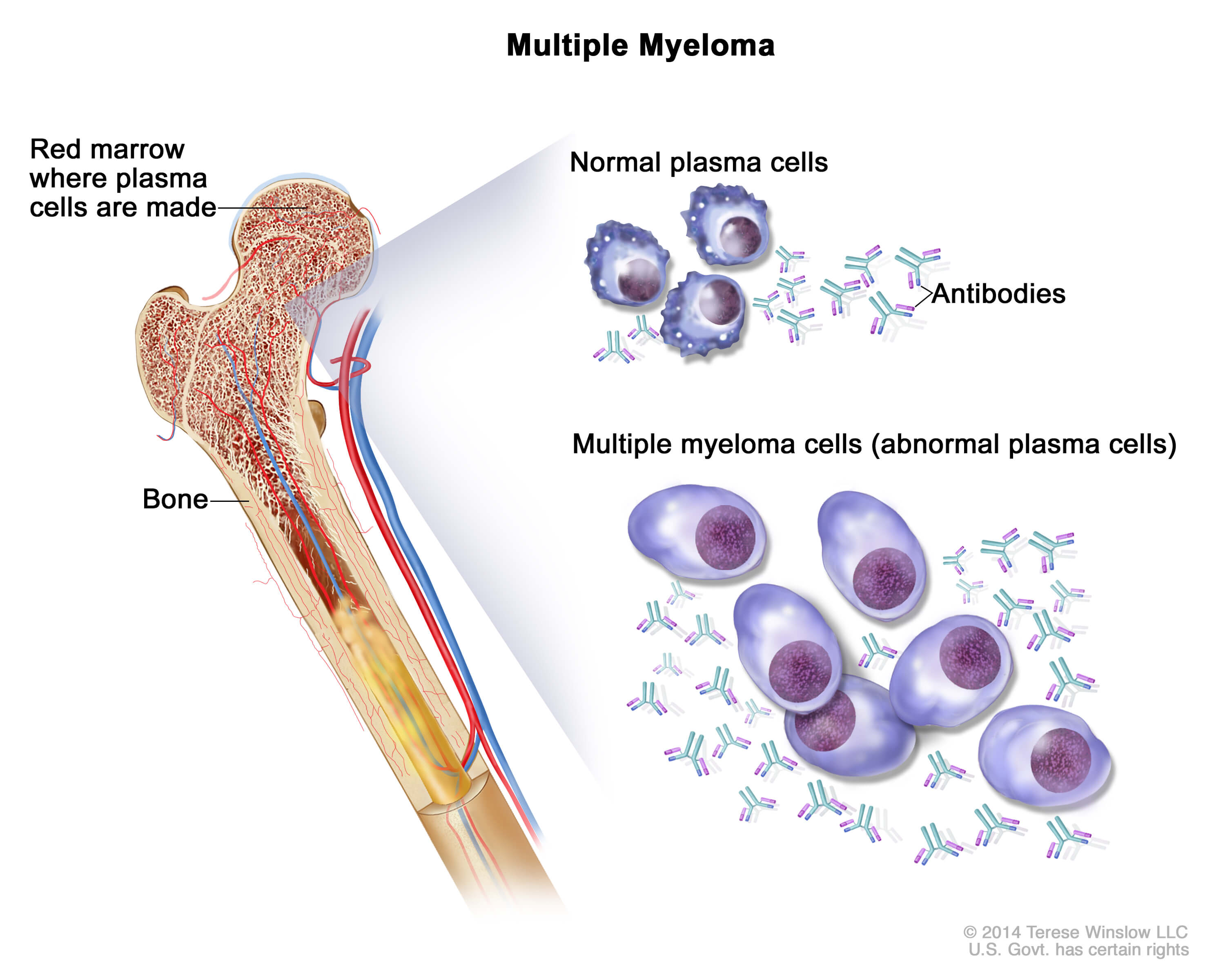 What is multiple myeloma?