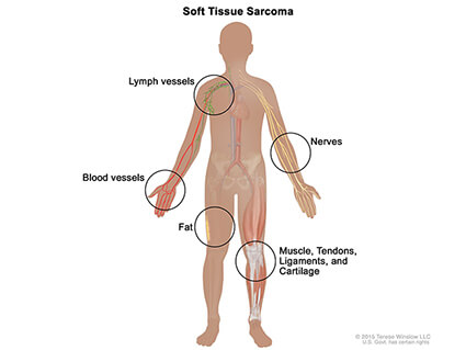 Soft tissue sarcoma forms in soft tissues of the body, including muscle, tendons, fat, blood vessels, lymph vessels, nerves, and tissue around joints.