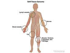Soft tissue sarcoma forms in soft tissues of the body, including muscle, tendons, fat, blood vessels, lymph vessels, nerves, and tissue around joints.
