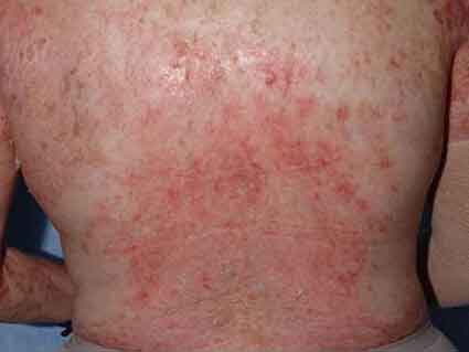 erythema skin rash caused by graft-versus host disease