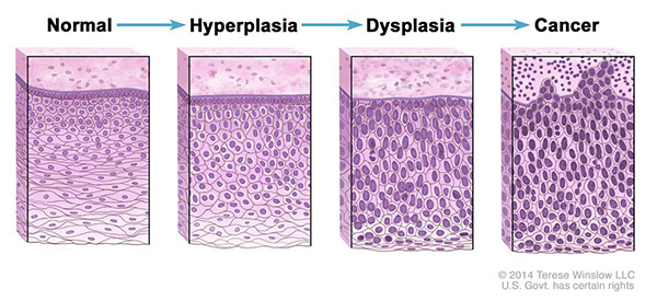 Drawing of four panels showing how normal cells may become cancer cells. The first panel shows normal cells. The second and third panels show abnormal cell changes called hyperplasia and dysplasia. The fourth panel shows cancer cells.