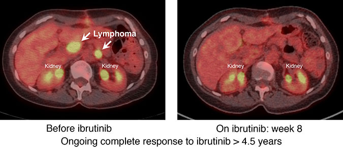 CT cross-section scans of abdomen with left image showing lymphoma highlighted in yellow and right image showing disappearance of cancer after 8 weeks on cancer drug ibrutinib.