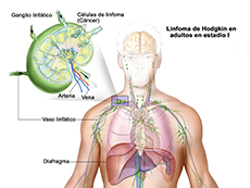 Ilustración anatómica de linfoma