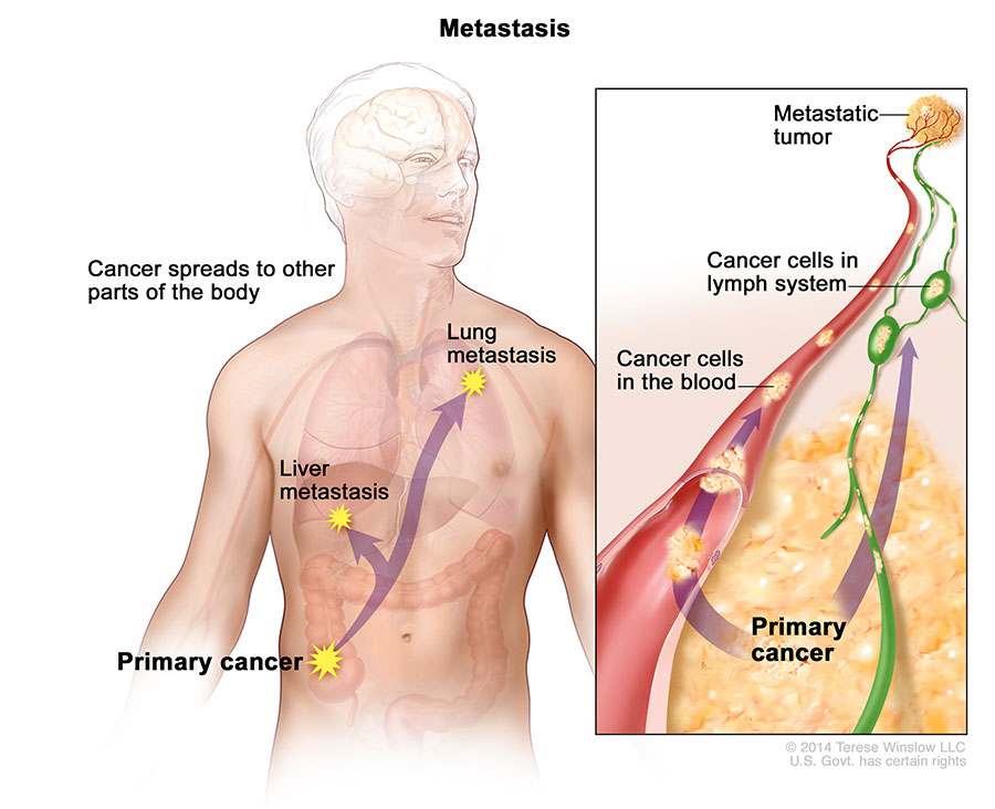 Metastasis; drawing shows primary cancer that has spread from the colon to other parts of the body (the lung and the brain). An inset shows cancer cells spreading from the primary cancer, through the blood and lymph system, to another part of the body where a metastatic tumor has formed.