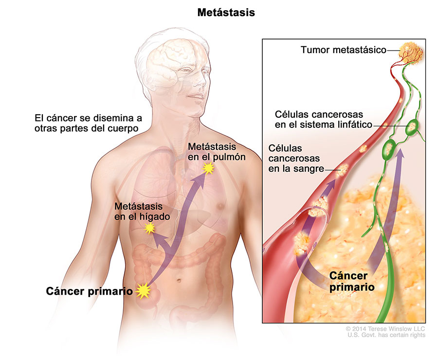 Metástasis; en la ilustración, se muestra un cáncer primario que se diseminó desde el colon hasta otras partes del cuerpo (pulmón y cerebro). En el panel, se muestran células cancerosas que se diseminan desde el cáncer primario, por medio de sistema vascular y linfático, hasta otra parte del cuerpo donde se formó un tumor metastásico.
