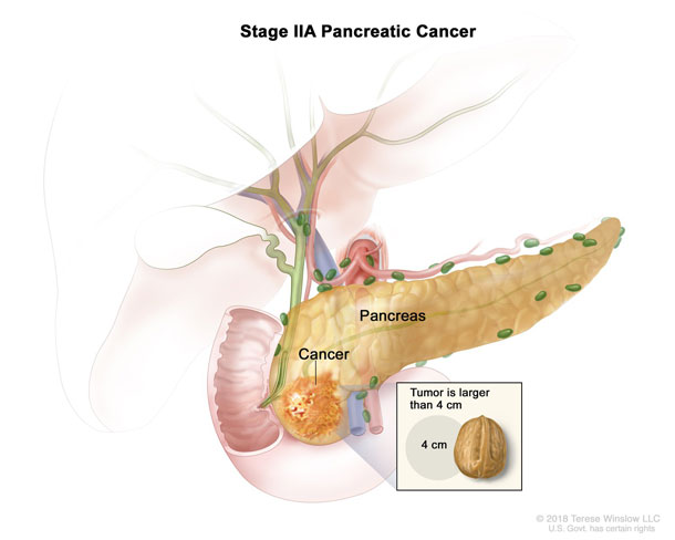 stage 2 A pancreatic cancer