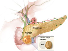 Stage IIa pancreatic cancer illustration