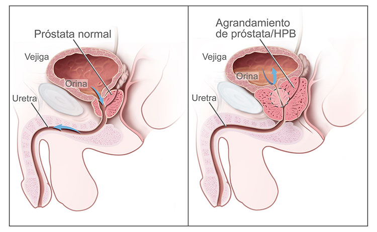 Flujo de orina en una próstata normal (izquierda) y agrandada (derecha). En el diagrama de la izquierda, la orina fluye con más facilidad. En la derecha, el flujo de orina está afectado porque la próstata agrandada oprime en la vejiga y en la uretra.