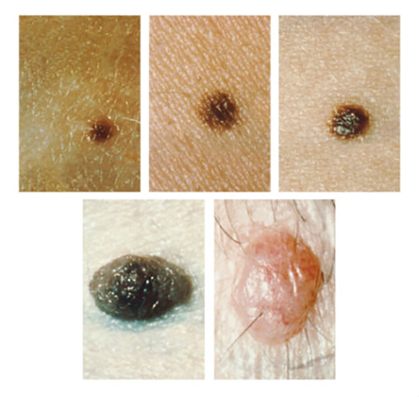 Common Moles Dysplastic Nevi And Risk Of Melanoma National Cancer