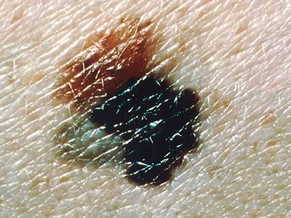 A blue-black melanoma that has irregular and scalloped borders. It has arisen from a dysplastic nevus (the pink-tan region at the upper left). The melanoma is about 12 millimeters wide (nearly 1/2 inch).