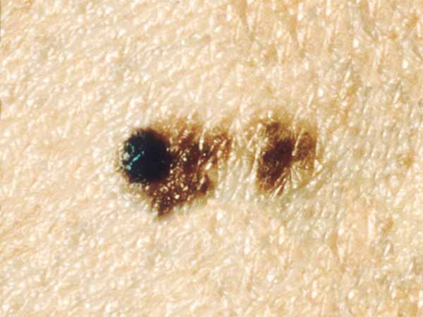 A dysplastic nevus with a black bump that was not there 18 months earlier. The black bump is a melanoma that is about 3 millimeters wide (about 1/8 inch).