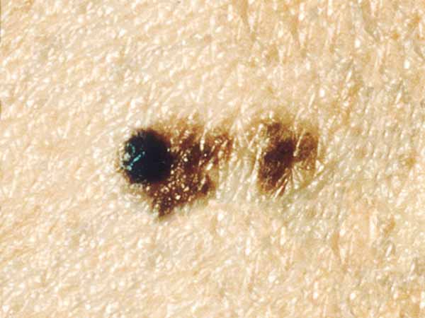 Common Moles Dysplastic Nevi And Risk Of Melanoma National Cancer