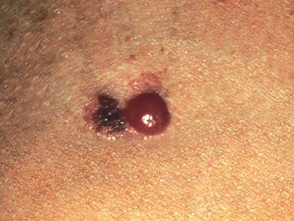 A melanoma with three parts—a dark brown or black area on the left, a red bump on the right, and an area that is lighter than the skin at the top. The melanoma is about 15 millimeters wide, or about as wide as a tube of lip balm.