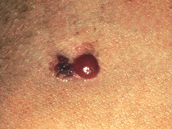 How is atypical melanoma diagnosed?