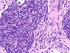 non-small-lung carcinoma