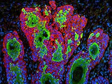 Squamous cell carcinoma cells