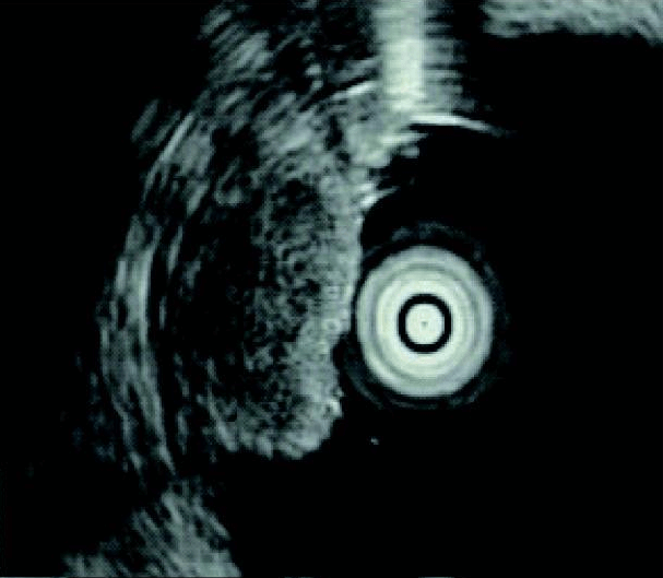 Endoscopic ultrasound of a neuroendocrine tumor (NET). 