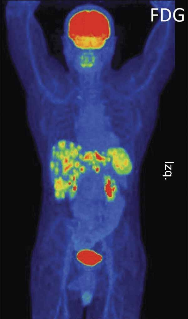 Una exploración con FDG-PET de un paciente con cáncer de la unión gastroesofágica.