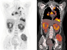 TC y TEP con fluorodesoxiglucosa de un paciente con carcinoma metastático de células renales.