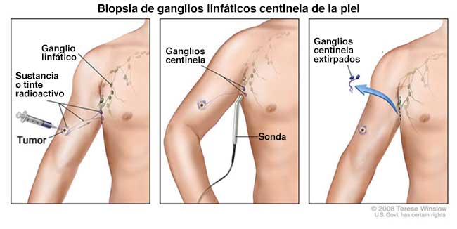 Biopsia de ganglios