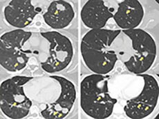 CT scans of a patient with metastatic bile duct cancer, before treatment with adoptive cell transfer and 20 months after treatment.