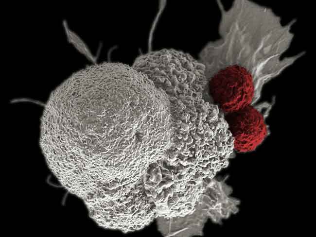 A pseudo-colored scanning electron micrograph of an oral squamous cancer cell (white) being attacked by two cytotoxic T cells (red), part of a natural immune response. 