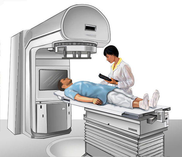 Illustration of patient in external beam radiation therapy machine.