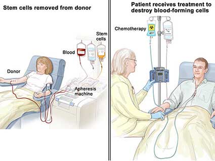 patient receiving stem cell transplant