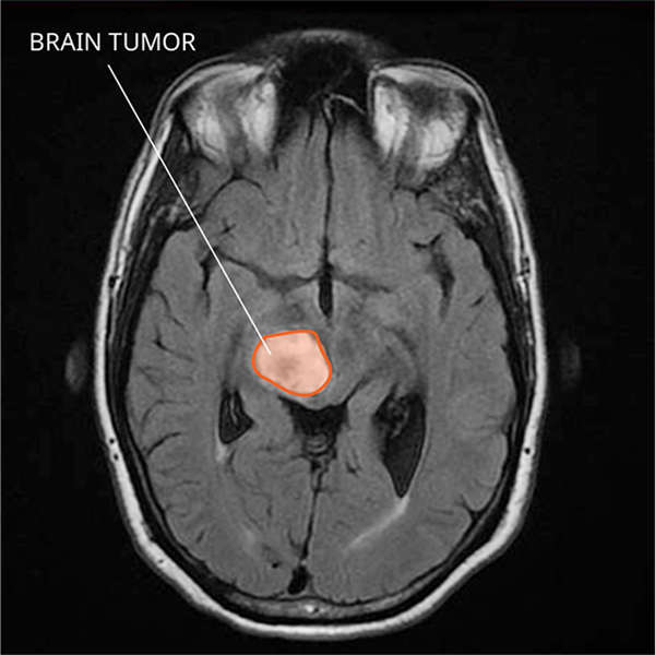 MRI of a diffuse midline glioma in the brain.