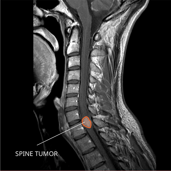 MRI of an ependymoma in the spine.